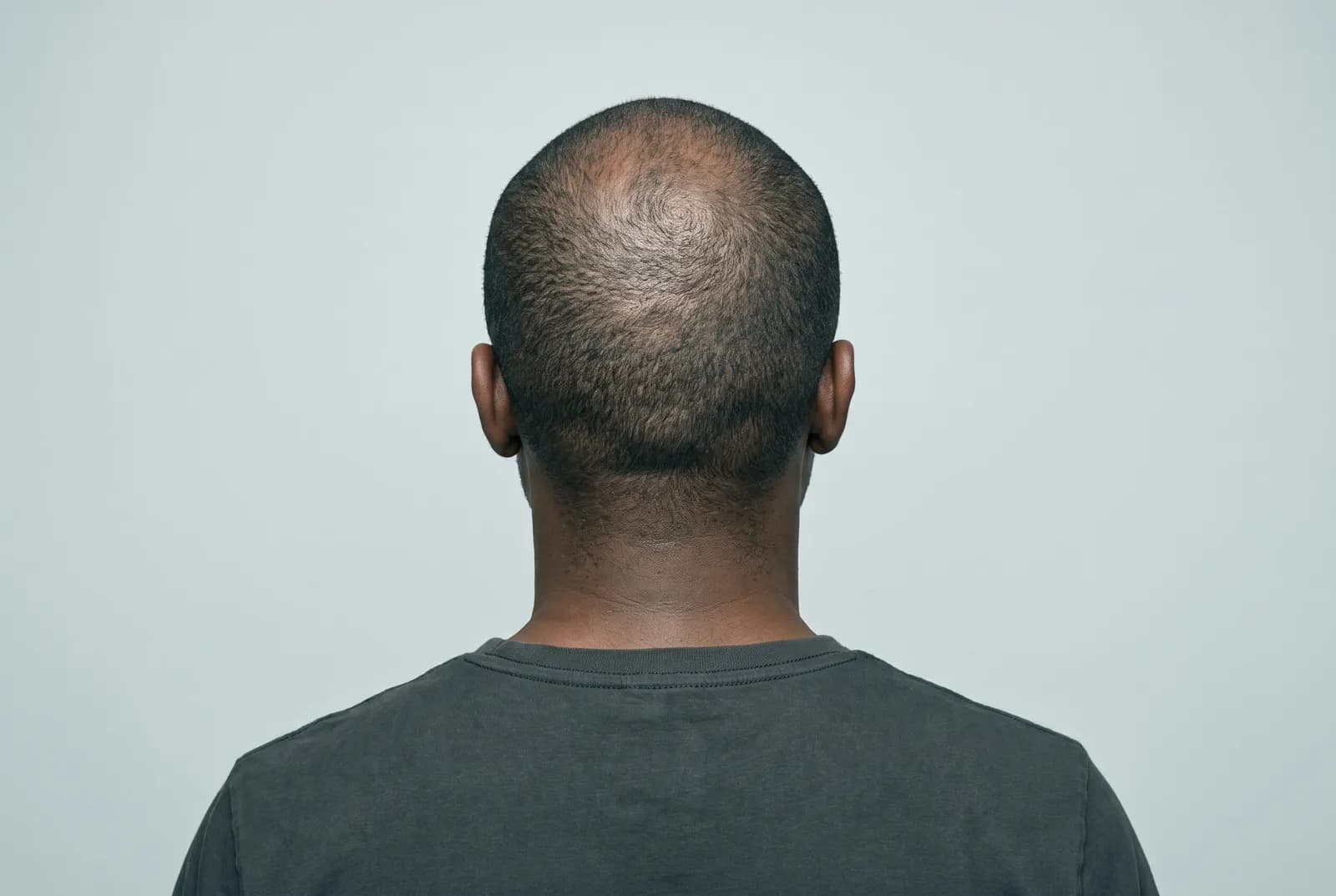 Back view of a man's buzzed head showing a thinning patch at the crown