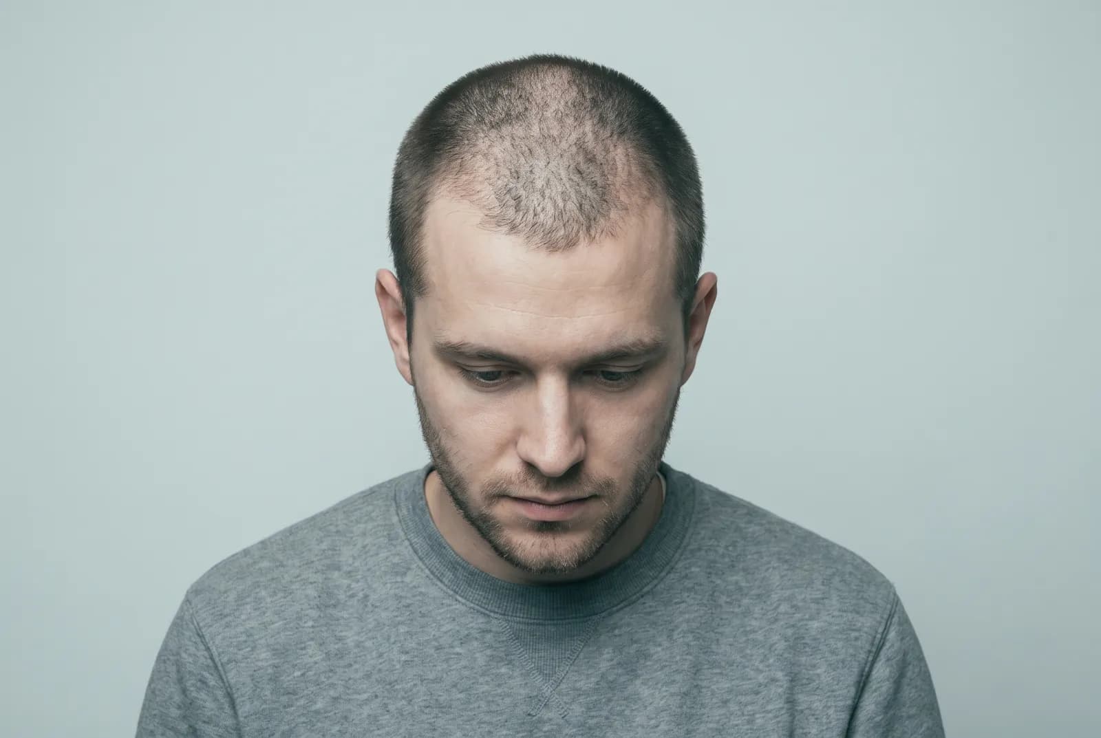 Man with diffuse thinning hair cropped to a short buzz cut, seen from slightly above