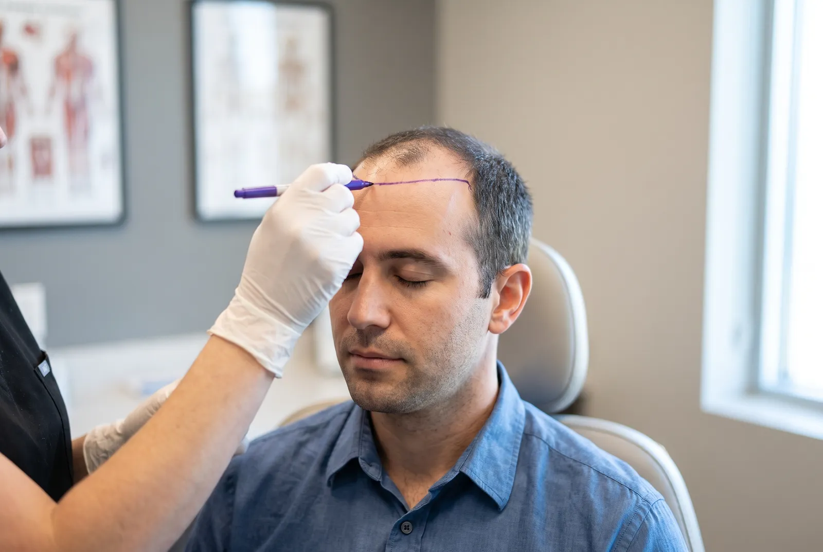 Surgeon drawing a planned hairline on a patient's forehead during a hair transplant consultation
